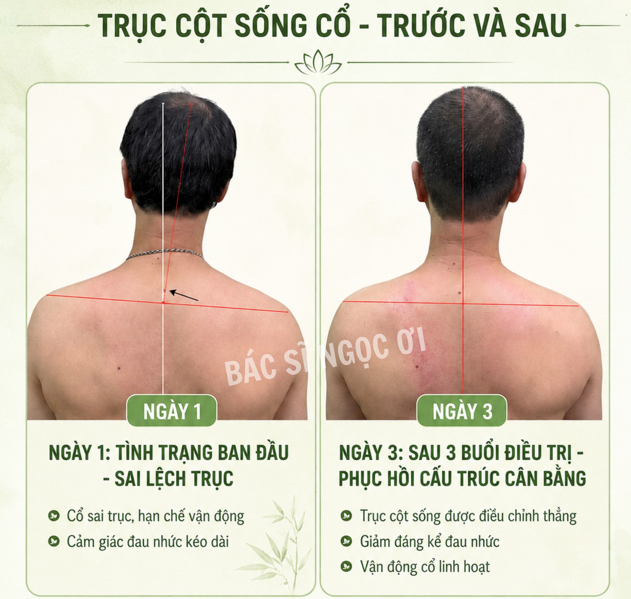Điều trị bệnh nhân lệch cột sống tại phòng khám Bs Võ Thị Hồng Ngọc