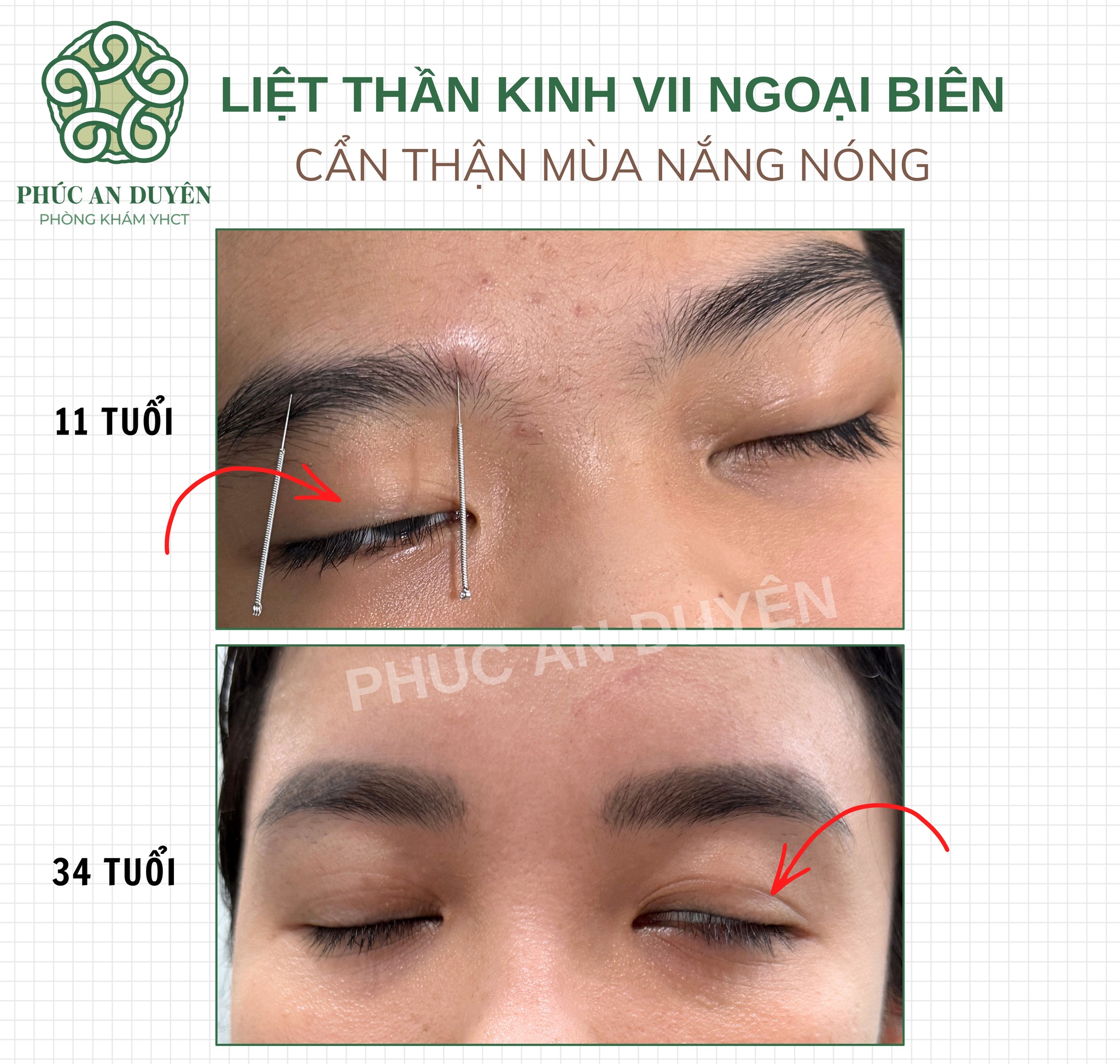 Châm cứu điều trị liệt mặt ngoại biên quận 7, TPHCM